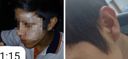 Ataque en Banda del Río Salí: Un alumno fue agredido con un lanzallamas casero
