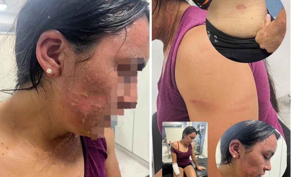 La hermana de un influencer tucumano fue atacada con agua hirviendo