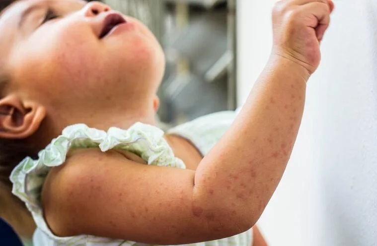 “El sarampión se llevó a mi hija: los padres deben saber lo peligrosa que es la enfermedad”